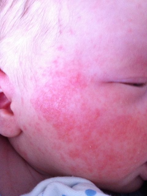алергия на лице ребёнка