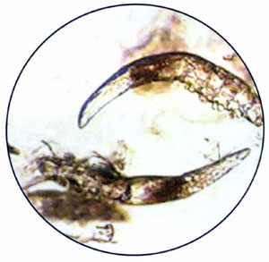 Микроскопические клеши-железницы, живущие в сальных железах, могут привести к сильному воспалению кожи